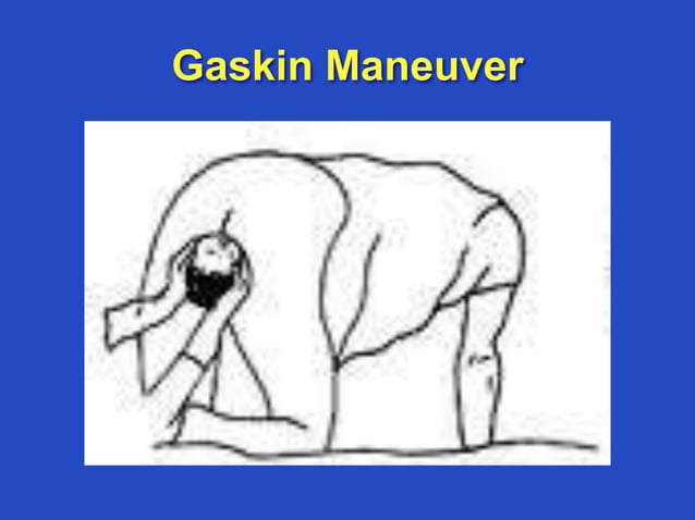 Shoulder Dystocia english PPT
