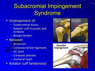 Subacromial Impingement
Syndrome
Impingement of:
– Subacromial bursa
– Rotator cuff muscles and
tendons
– Biceps tendon

Between
–
–
–
–
–

Acromion
Coracoacromial ligament
AC joint
Coracoid process
Humeral head

Rotator cuff tendonosis

 