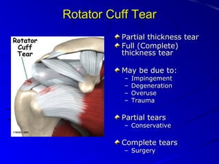 Rotator Cuff Tear
Partial thickness tear
Full (Complete)
thickness tear
May be due to:
–
–
–
–

Impingement
Degeneration
Overuse
Trauma

Partial tears

– Conservative

Complete tears
– Surgery

 
