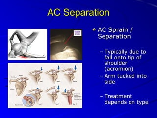 AC Separation
AC Sprain /
Separation
– Typically due to
fall onto tip of
shoulder
(acromion)
– Arm tucked into
side
– Treatment
depends on type

 