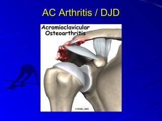 AC Arthritis / DJD

 