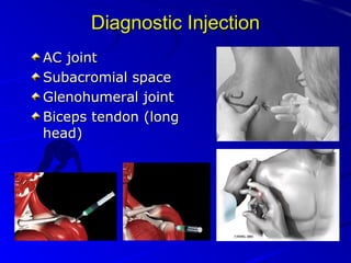 Diagnostic Injection
AC joint
Subacromial space
Glenohumeral joint
Biceps tendon (long
head)

 