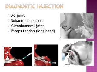    AC joint
   Subacromial space
   Glenohumeral joint
   Biceps tendon (long head)
 