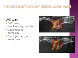    U/S scan
     Cuff tears,
      tendinopathy, bursitis
     Undercalls cuff
      pathology
     Can inject at the
      same time
 