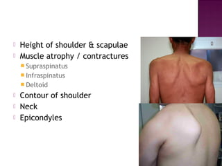    Height of shoulder & scapulae
   Muscle atrophy / contractures
     Supraspinatus
     Infraspinatus
     Deltoid
   Contour of shoulder
   Neck
   Epicondyles
 
