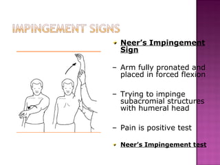 Neer’s Impingement
  Sign

– Arm fully pronated and
  placed in forced flexion

– Trying to impinge
  subacromial structures
  with humeral head

– Pain is positive test

  Neer’s Impingement test
 