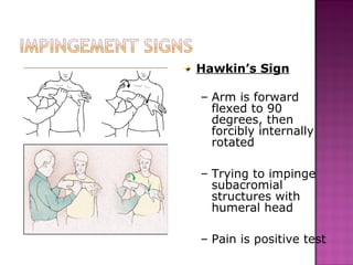 Hawkin’s Sign

– Arm is forward
  flexed to 90
  degrees, then
  forcibly internally
  rotated

– Trying to impinge
  subacromial
  structures with
  humeral head

– Pain is positive test
 