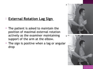    External Rotation Lag Sign

   The patient is asked to maintain the
    position of maximal external rotation
    actively as the examiner maintaining
    support of the arm at the elbow.
   The sign is positive when a lag or angular
    drop
 