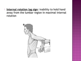   Internal rotation lag sign: inability to hold hand
    away from the lumbar region in maximal internal
    rotation
 