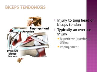    Injury to long head of
    biceps tendon
   Typically an overuse
    injury
     Repetitive   (overhead)
      lifting
     Impingement
 