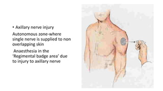 • Axillary nerve injury
Autonomous zone-where
single nerve is supplied to non
overlapping skin
Anaesthesia in the
‘Regimental badge area’ due
to injury to axillary nerve
 