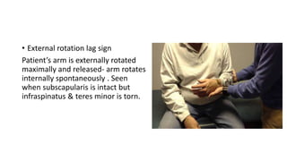 • External rotation lag sign
Patient’s arm is externally rotated
maximally and released- arm rotates
internally spontaneously . Seen
when subscapularis is intact but
infraspinatus & teres minor is torn.
 