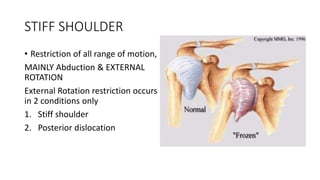 STIFF SHOULDER
• Restriction of all range of motion,
MAINLY Abduction & EXTERNAL
ROTATION
External Rotation restriction occurs
in 2 conditions only
1. Stiff shoulder
2. Posterior dislocation
 