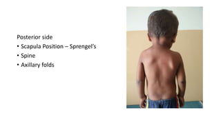 Posterior side
• Scapula Position – Sprengel’s
• Spine
• Axillary folds
 