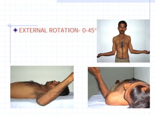 EXTERNAL ROTATION- 0-45°
 