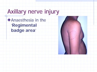 Axillary nerve injury
 Anaesthesia in the
 ‘Regimental
 badge area’
 