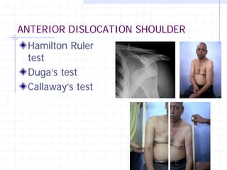 ANTERIOR DISLOCATION SHOULDER
 Hamilton Ruler
 test
 Duga’s test
 Callaway’s test
 