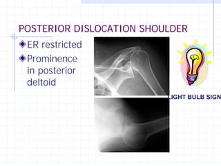POSTERIOR DISLOCATION SHOULDER
 ER restricted
 Prominence
 in posterior
 deltoid
                          LIGHT BULB SIGN
 