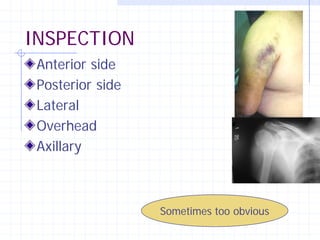 INSPECTION
 Anterior side
 Posterior side
 Lateral
 Overhead
 Axillary



                  Sometimes too obvious
 
