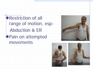 Restriction of all
range of motion, esp-
 Abduction & ER
Pain on attempted
movements
 