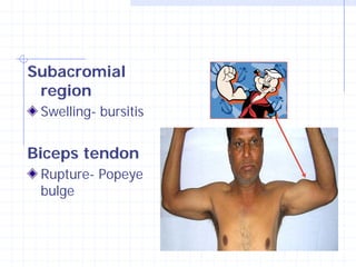 Subacromial
 region
 Swelling- bursitis


Biceps tendon
 Rupture- Popeye
 bulge
 