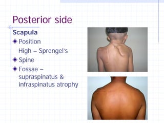 Posterior side
Scapula
  Position
  High – Sprengel’s
  Spine
  Fossae –
  supraspinatus &
  infraspinatus atrophy
 