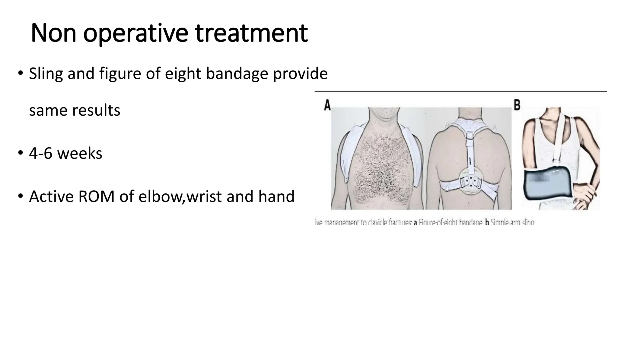 Non operative treatment
• Sling and figure of eight bandage provide
same results
• 4-6 weeks
• Active ROM of elbow,wrist and hand
 