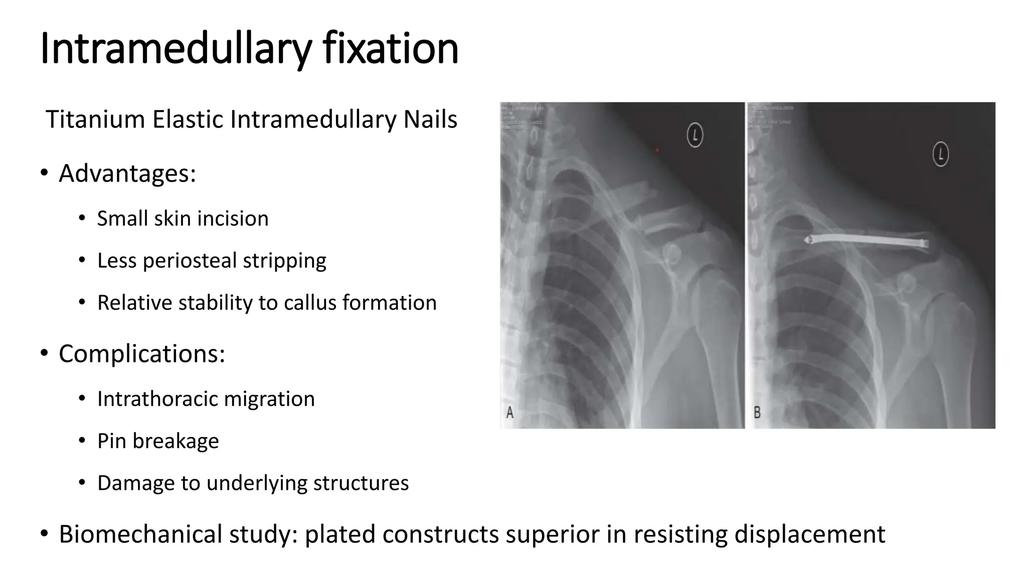 Intramedullary fixation
Titanium Elastic Intramedullary Nails
• Advantages:
• Small skin incision
• Less periosteal stripping
• Relative stability to callus formation
• Complications:
• Intrathoracic migration
• Pin breakage
• Damage to underlying structures
• Biomechanical study: plated constructs superior in resisting displacement
 