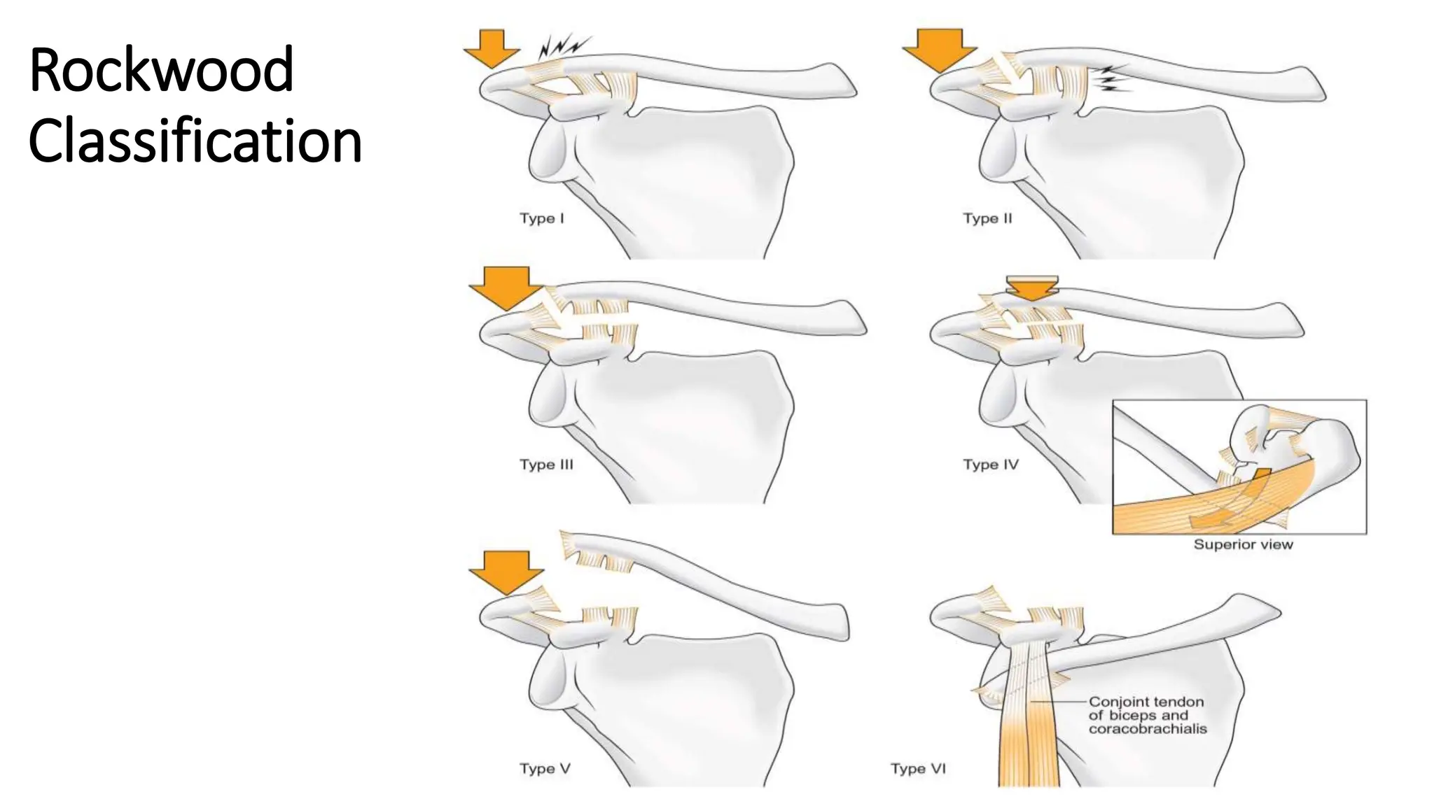 Rockwood
Classification
 