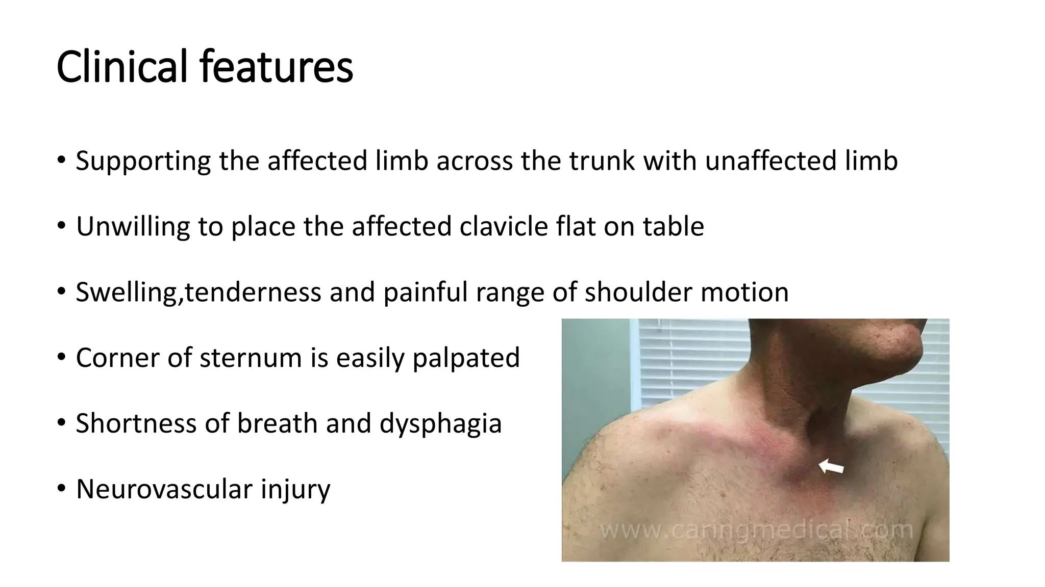 Clinical features
• Supporting the affected limb across the trunk with unaffected limb
• Unwilling to place the affected clavicle flat on table
• Swelling,tenderness and painful range of shoulder motion
• Corner of sternum is easily palpated
• Shortness of breath and dysphagia
• Neurovascular injury
 