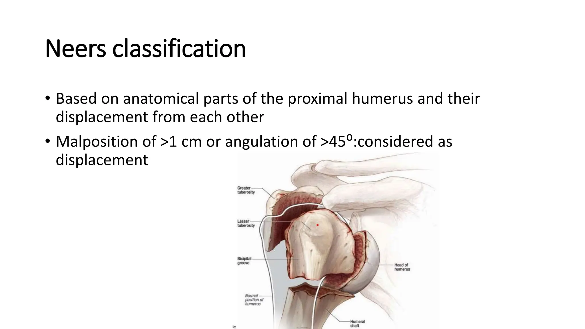 Neers classification
• Based on anatomical parts of the proximal humerus and their
displacement from each other
• Malposition of >1 cm or angulation of >45⁰:considered as
displacement
 