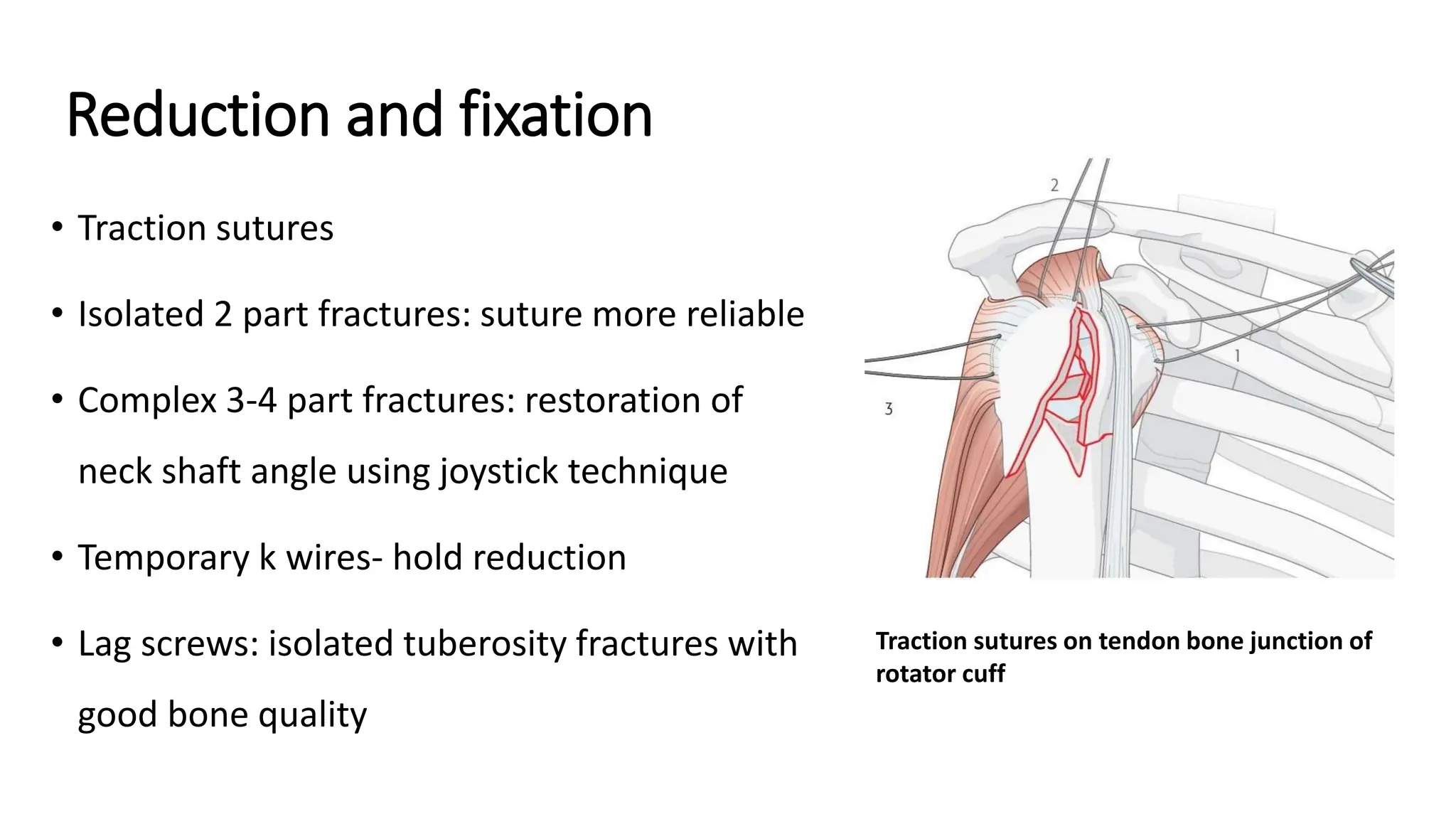 Reduction and fixation
• Traction sutures
• Isolated 2 part fractures: suture more reliable
• Complex 3-4 part fractures: restoration of
neck shaft angle using joystick technique
• Temporary k wires- hold reduction
• Lag screws: isolated tuberosity fractures with
good bone quality
Traction sutures on tendon bone junction of
rotator cuff
 