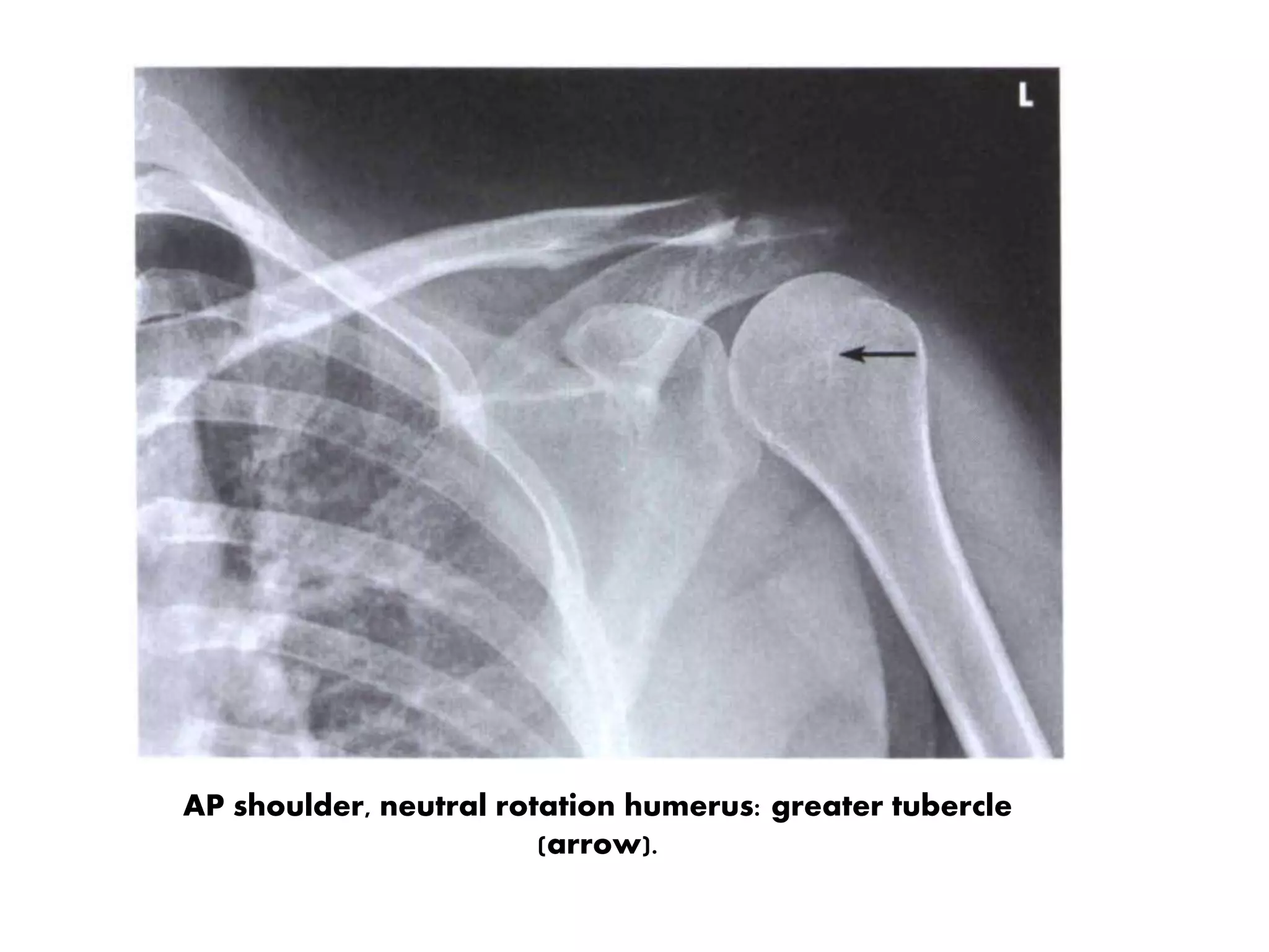 Shoulder girdle presentation | PPTX