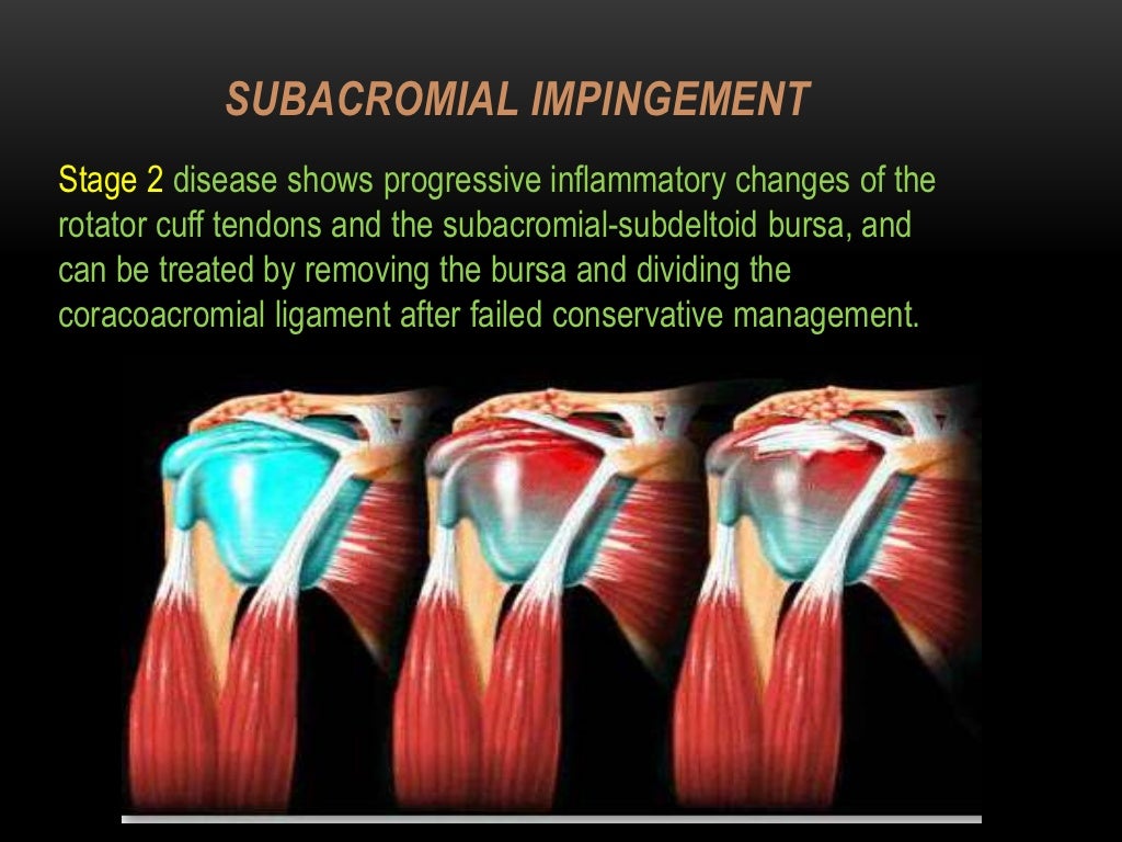 Shoulder impingement