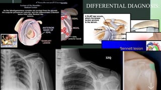 shoulder impingement in sports physiotherapy | PPTX