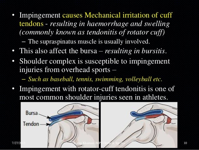 Shoulder impingement syndrome