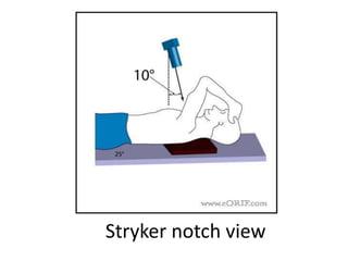 Stryker notch view
 
