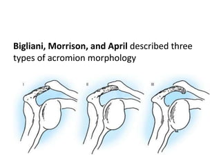 Bigliani, Morrison, and April described three
types of acromion morphology
 