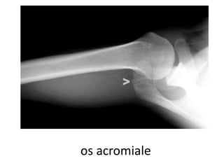 os acromiale
 