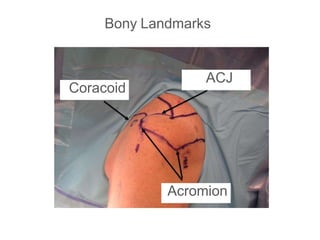 Bony Landmarks
ACJ
Coracoid
Acromion
 