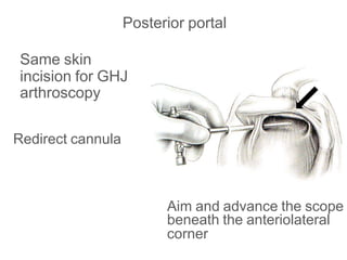 Posterior portal
Same skin
incision for GHJ
arthroscopy
Redirect cannula
Aim and advance the scope
beneath the anteriolateral
corner
 