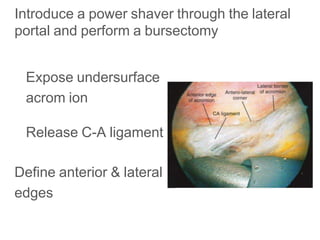Introduce a power shaver through the lateral
portal and perform a bursectomy
Expose undersurface
acrom ion
Release C-A ligament
Define anterior & lateral
edges
 