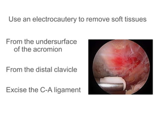 Use an electrocautery to remove soft tissues
From the undersurface
of the acromion
From the distal clavicle
Excise the C-A ligament
 