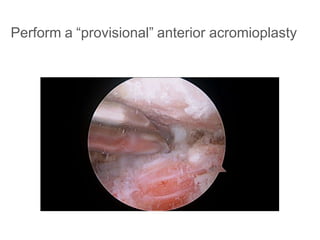 Perform a “provisional” anterior acromioplasty
 
