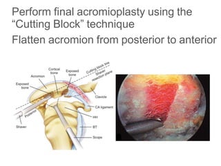 Perform final acromioplasty using the
“Cutting Block” technique
Flatten acromion from posterior to anterior
 
