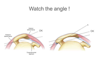 Watch the angle !
ΟΚ ΟΚ
 