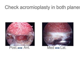 Check acromioplasty in both planes
Post. Ant. Med. Lat.
 