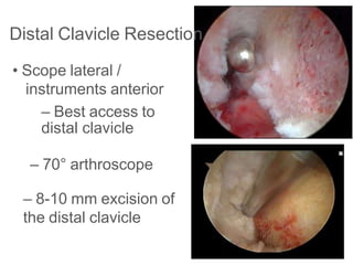Distal Clavicle Resection
• Scope lateral /
instruments anterior
– Best access to
distal clavicle
– 70° arthroscope
– 8-10 mm excision of
the distal clavicle
 