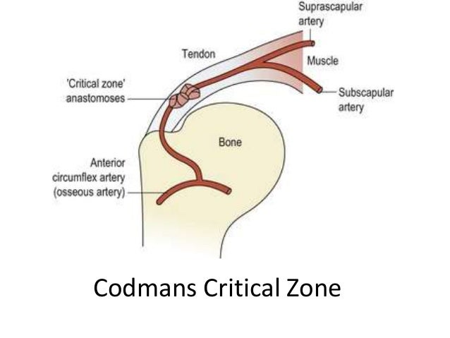 Shoulder impingement syndrome