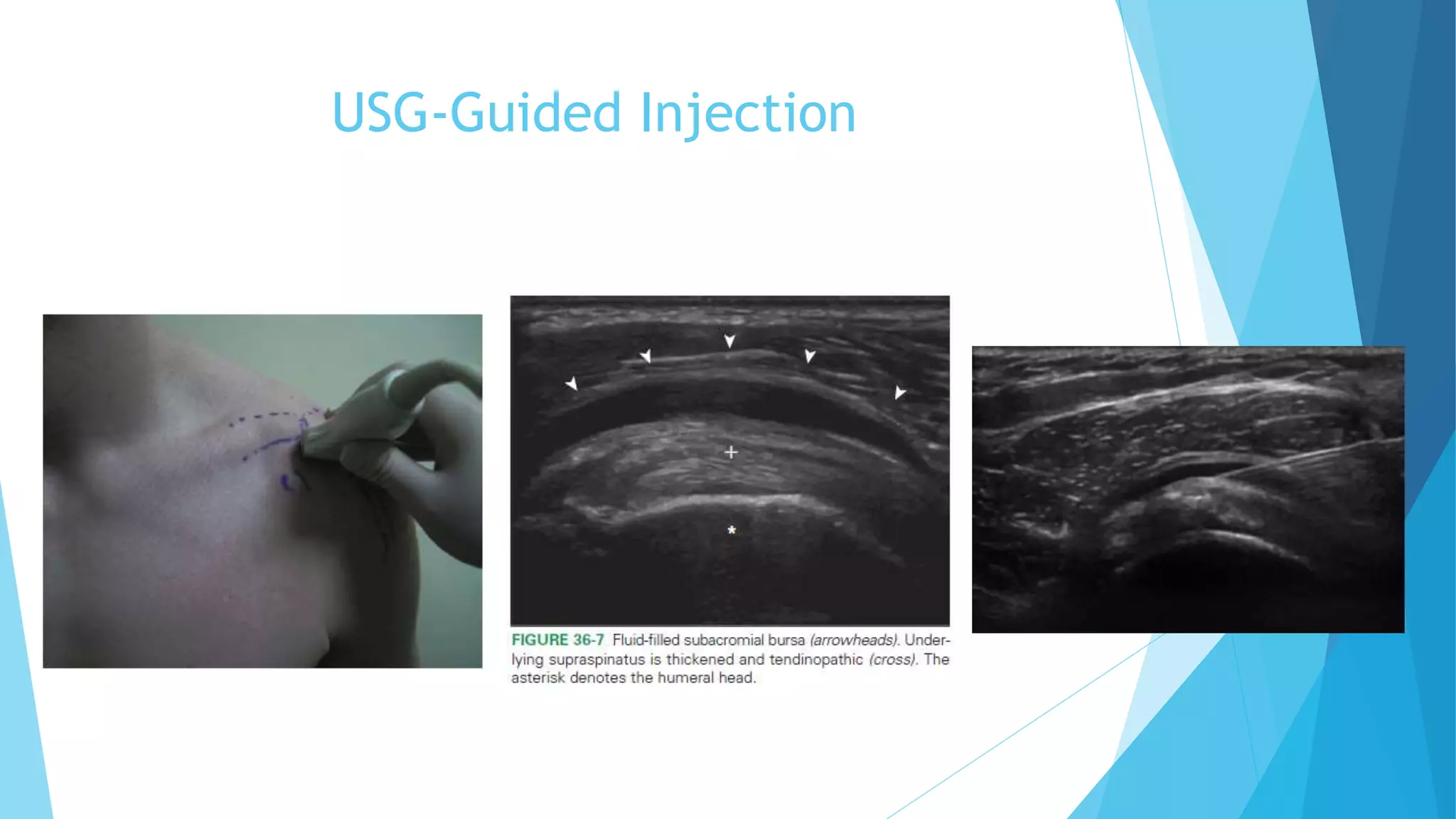 Shoulder Injection | PPTX